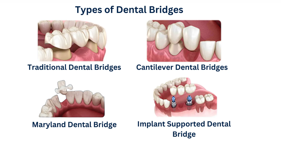 Understanding the Types of Dental Bridges: Which One is Right for You?